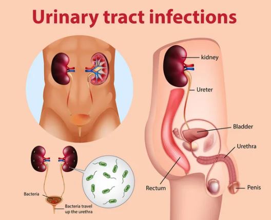 nephrology stones urinary tract infection obstruction